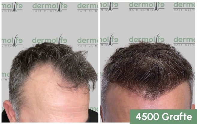 Mbjellja e flokut ne tirane