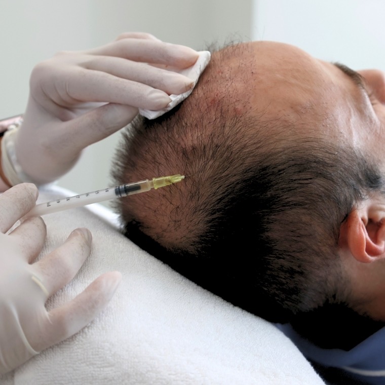 Trajtimi i flokut me plazma