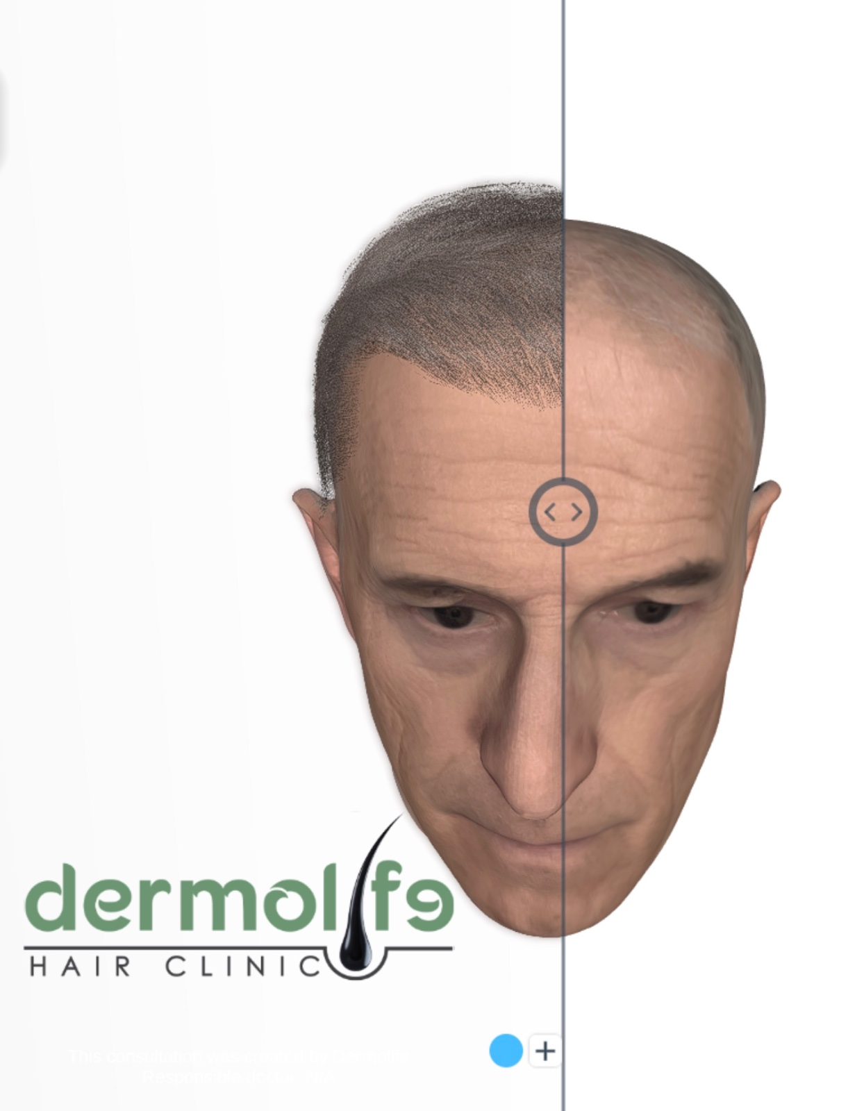 Transplanti i flokëve dhe sëmundjet kronike