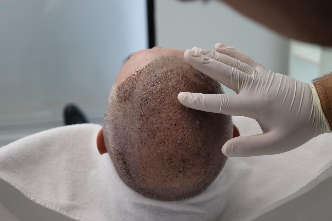 Transplanti i flokëve për pacientët me hipotiroidizëm